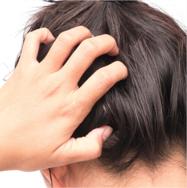 Itchy Scalp