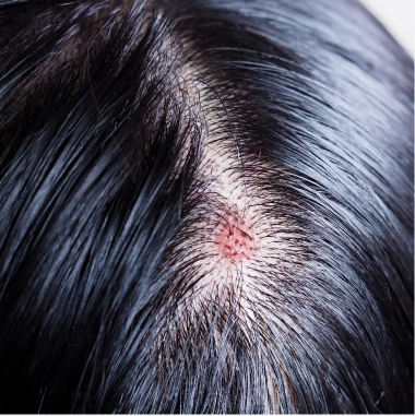 Scalp Acne