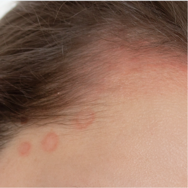 Scalp Redness