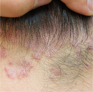 Micro-Inflammation